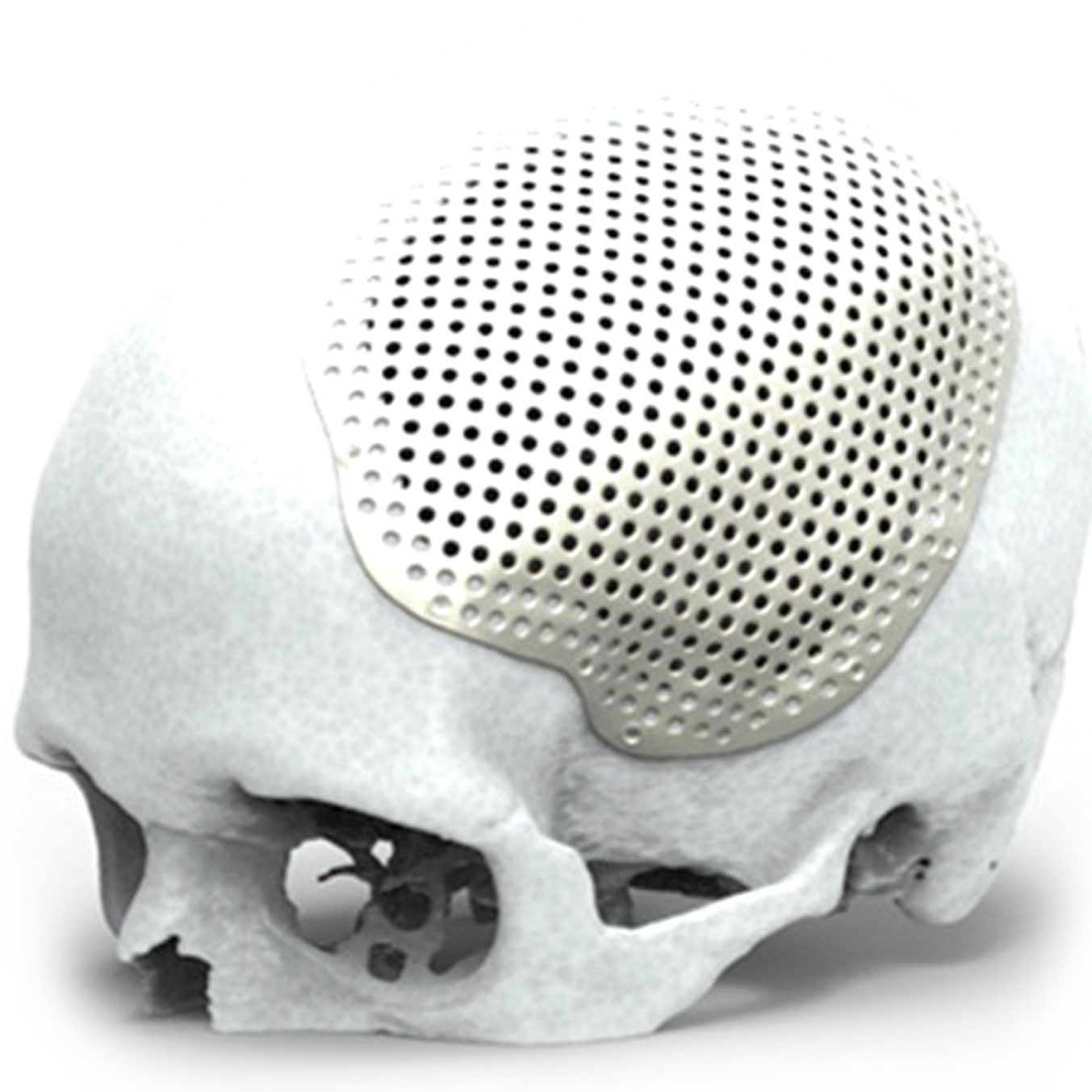 Stella Cranial Platinum Plate